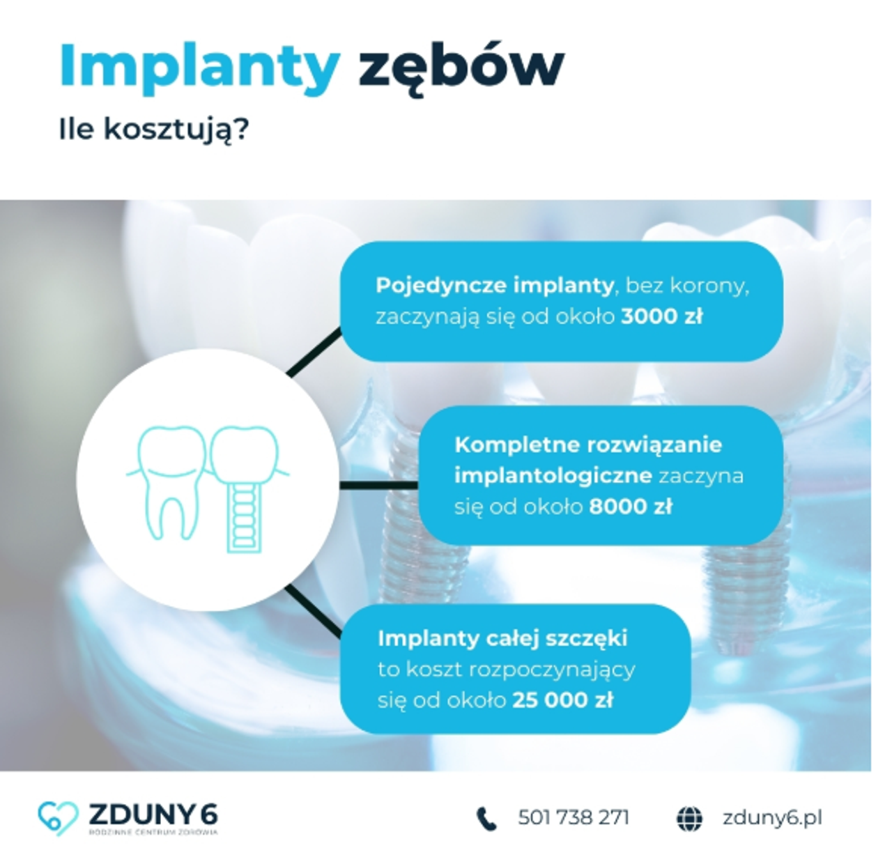 Infografika Zduny6 – cennik implantów zębów: od 3000 zł do 25 000 zł