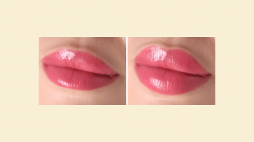Lip Filler