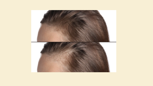Hair Thickness and Density 