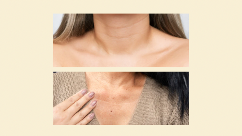 Neck & Chest Filler 