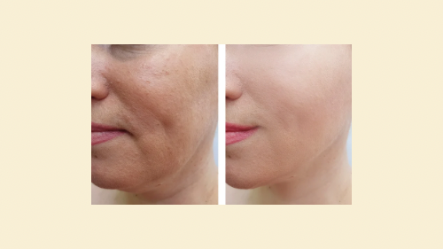 Nasolabial Filler 