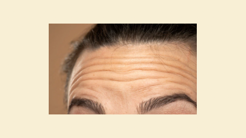 Frontalis wrinkles and lines 
