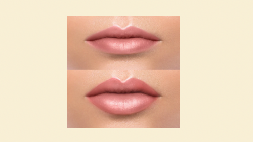 Lip Filler Before & After 