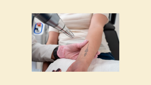 Tattoo Removal 