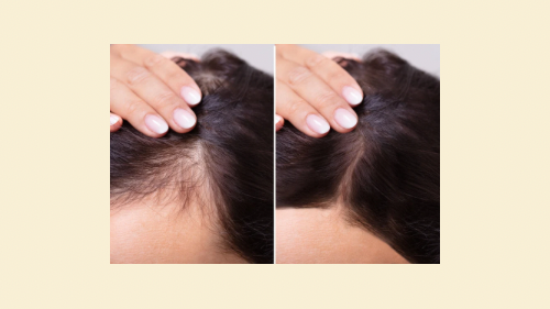 Hair Follicle Regrowth 