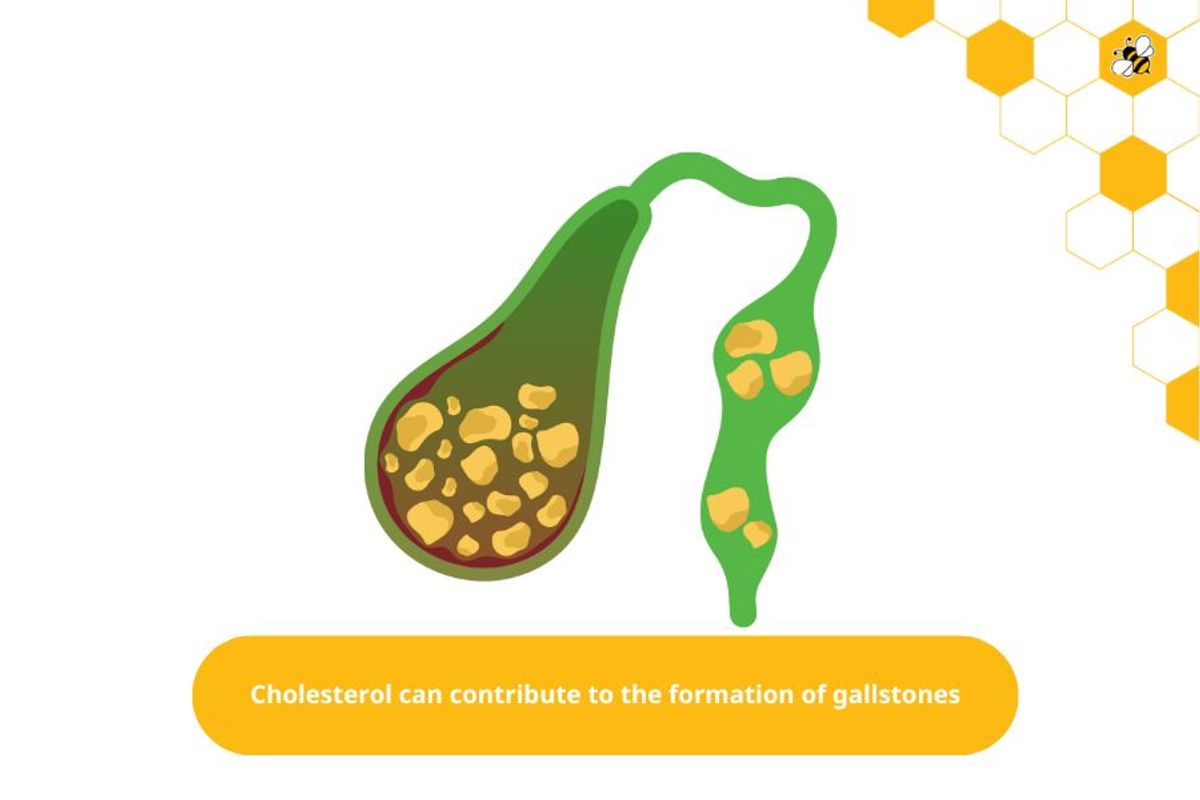 Cholesterol can contribute to the formation of gallstones