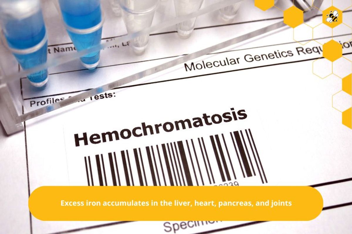 Excess iron accumulates in the liver, heart, pancreas, and joints