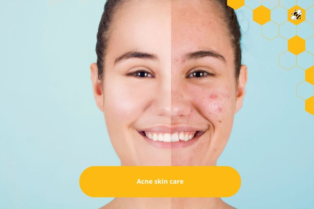 Acne skin care