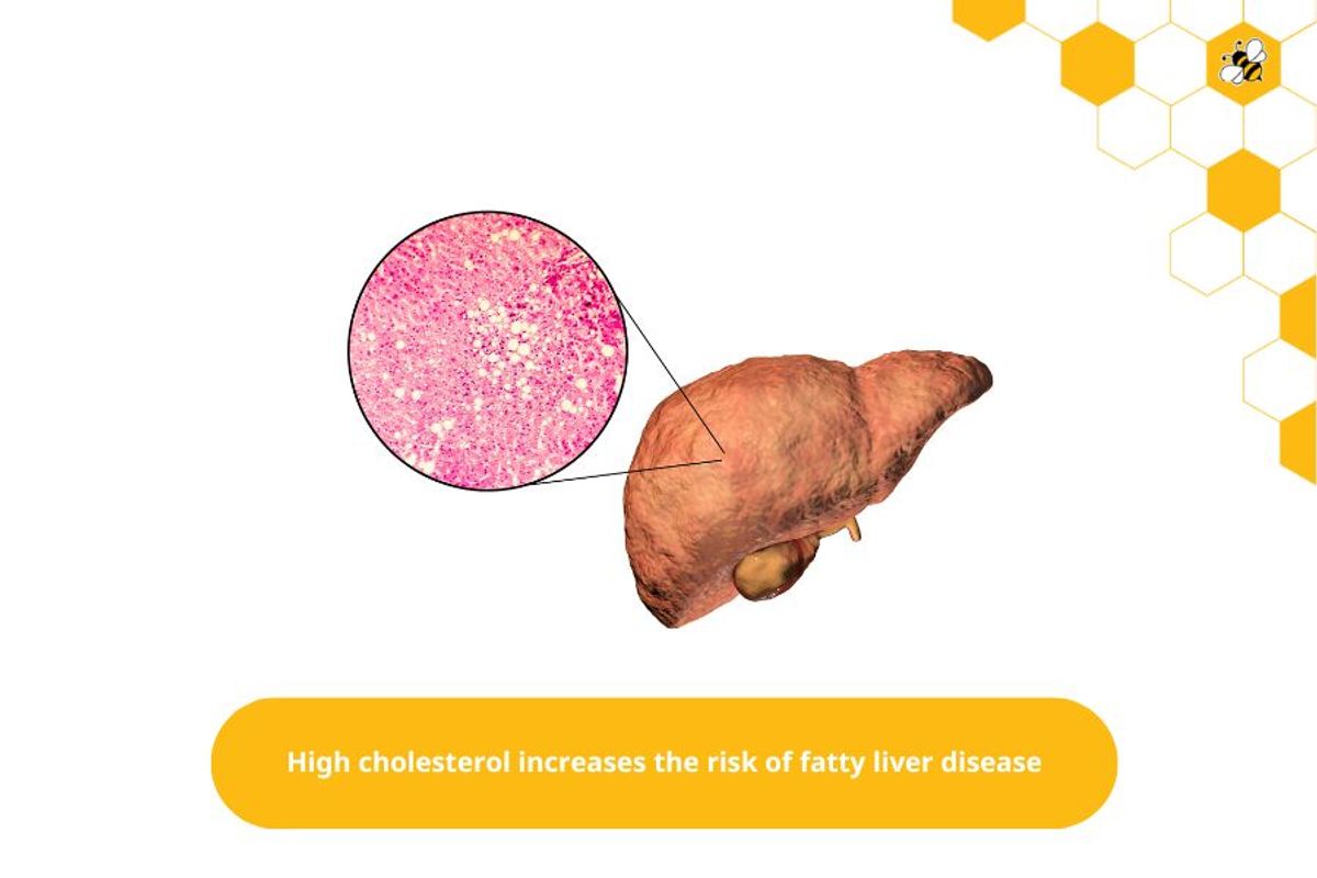 High cholesterol increases the risk of fatty liver disease