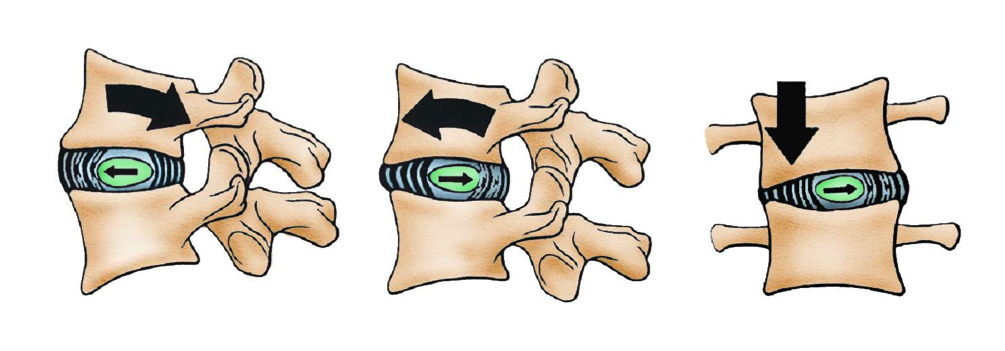 ¿Qué es una hernia discal?