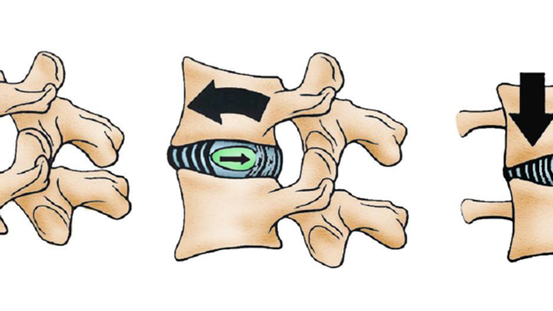 ¿Qué es una hernia discal?