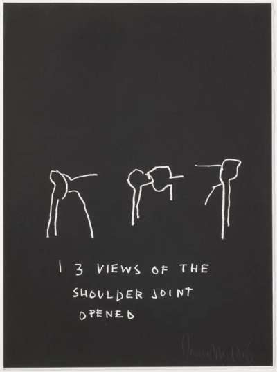 Jean-Michel Basquiat: Anatomy, 3 Views Of The Shoulder Joint Opened - Signed Print