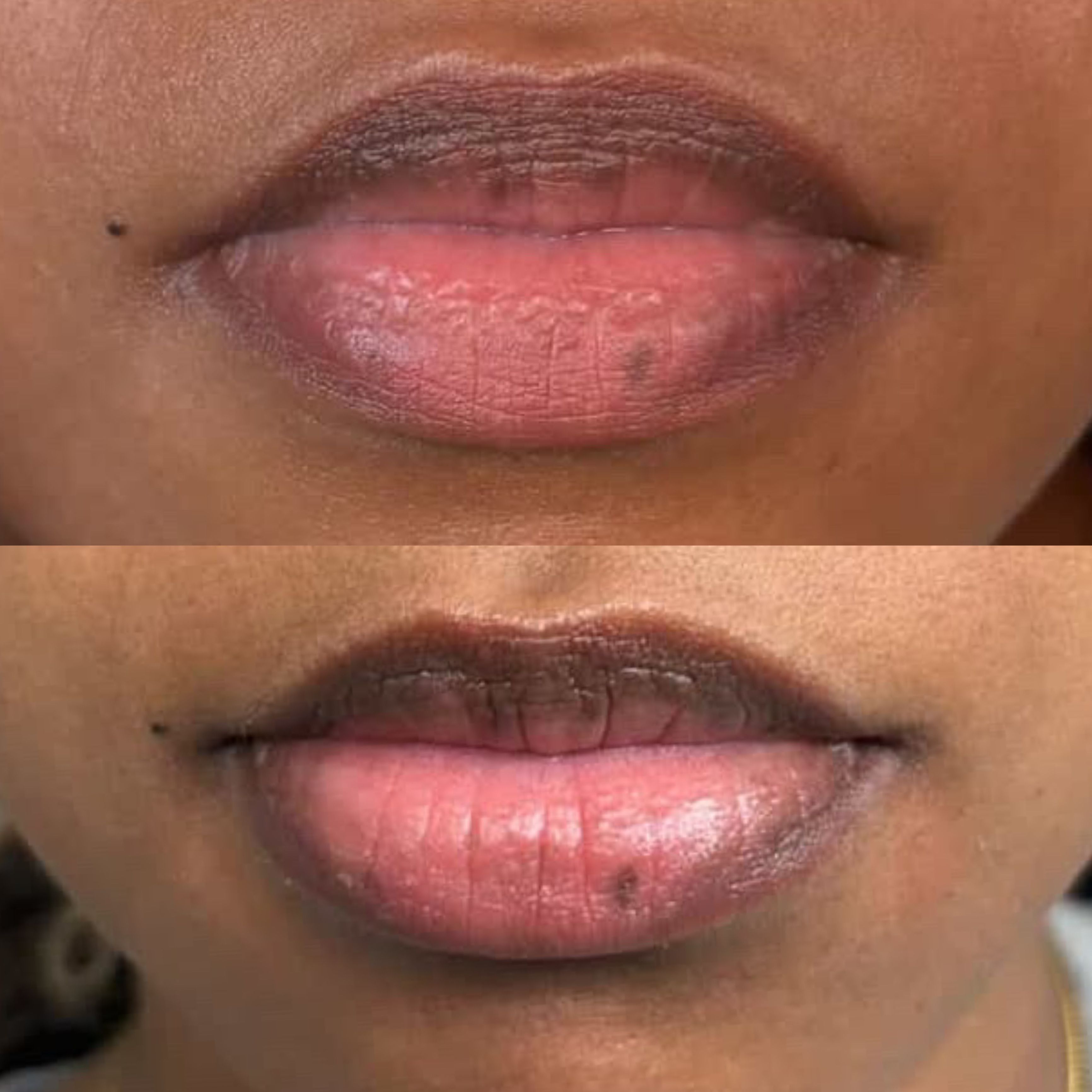 Dark Lip Neutralization before and after