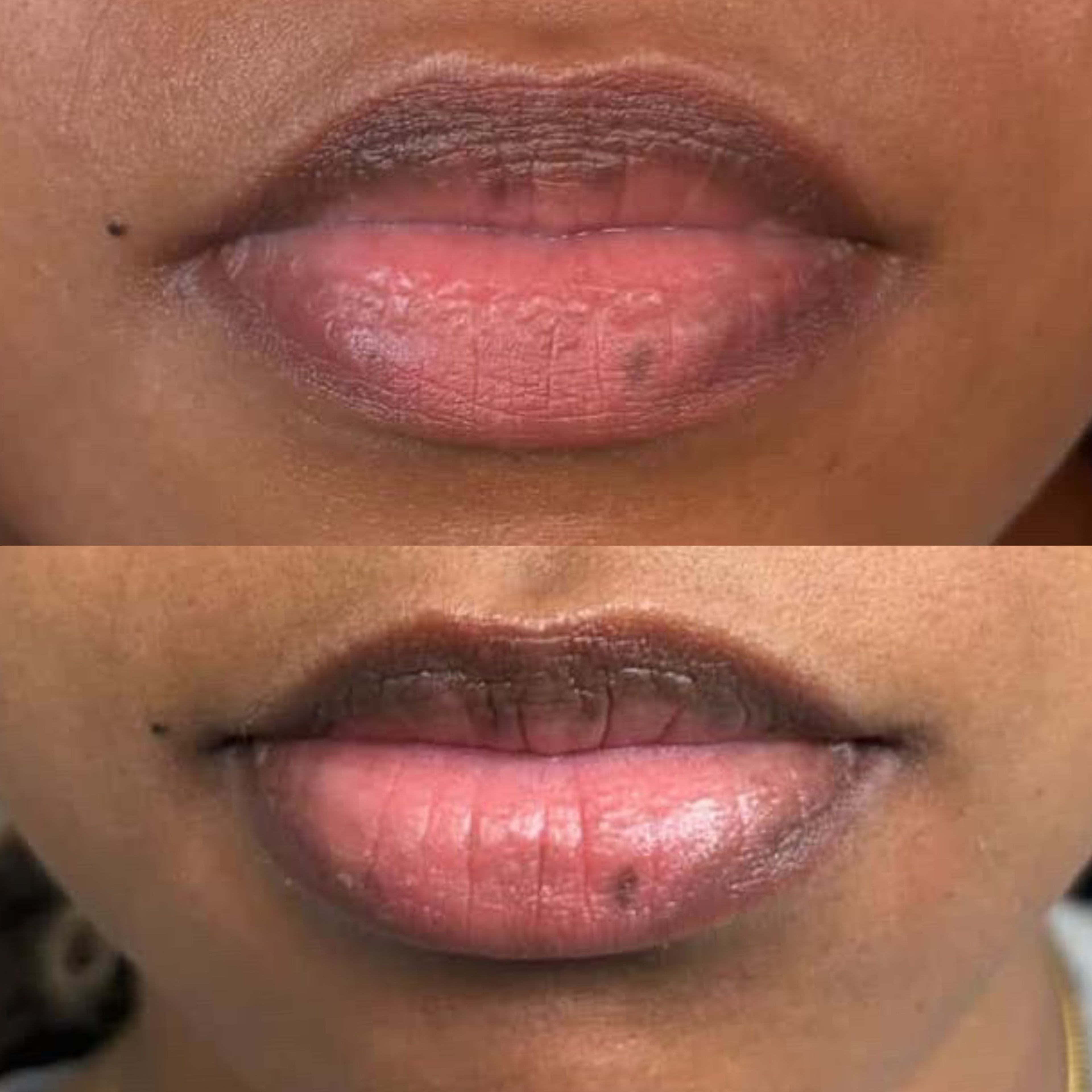 Dark Lip Neutralization before and after