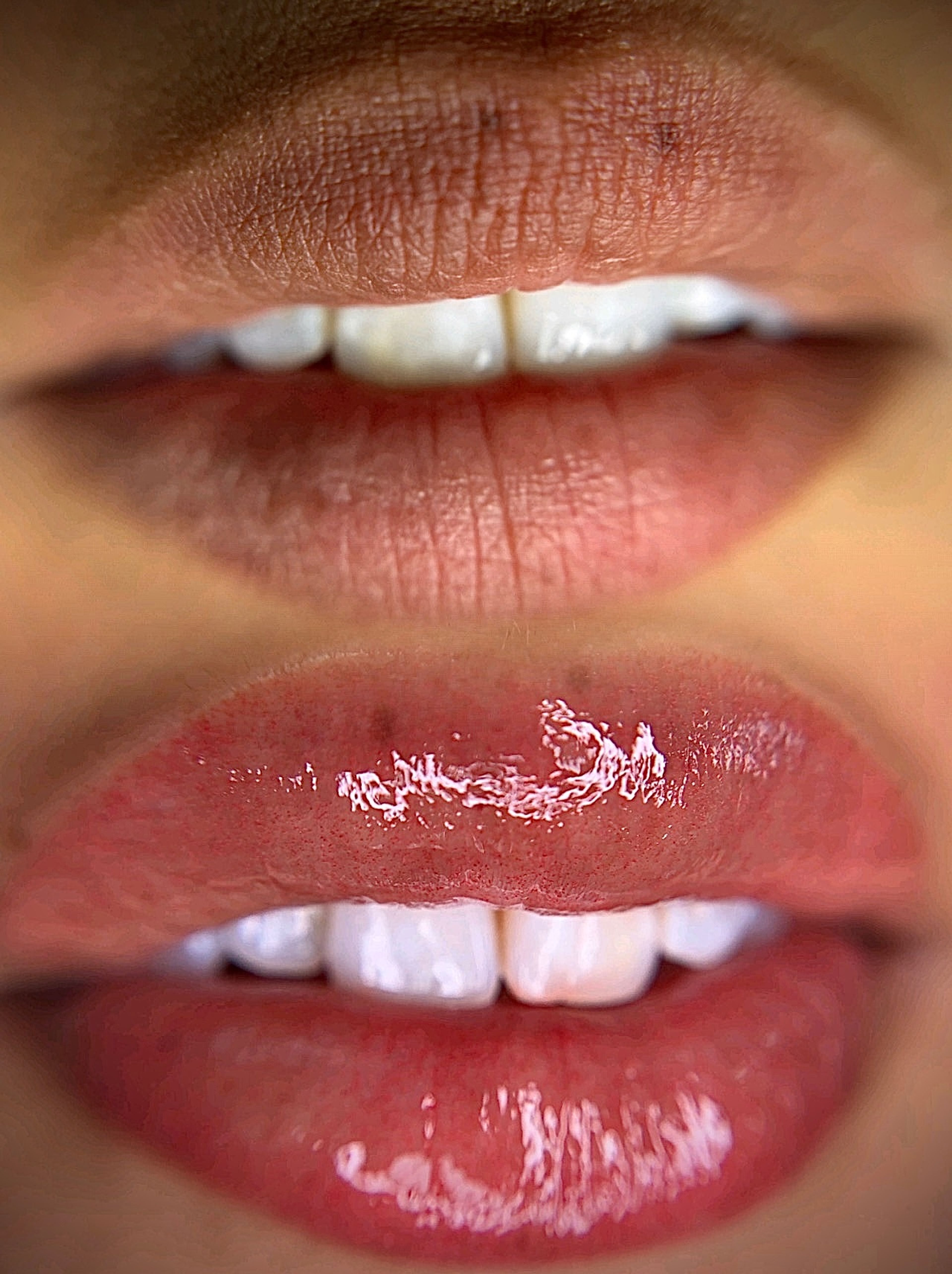 Lip Neutralization Before and After