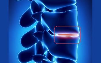Why Lumbar Disc Degeneration Is Not the Cause of Your Back Pain