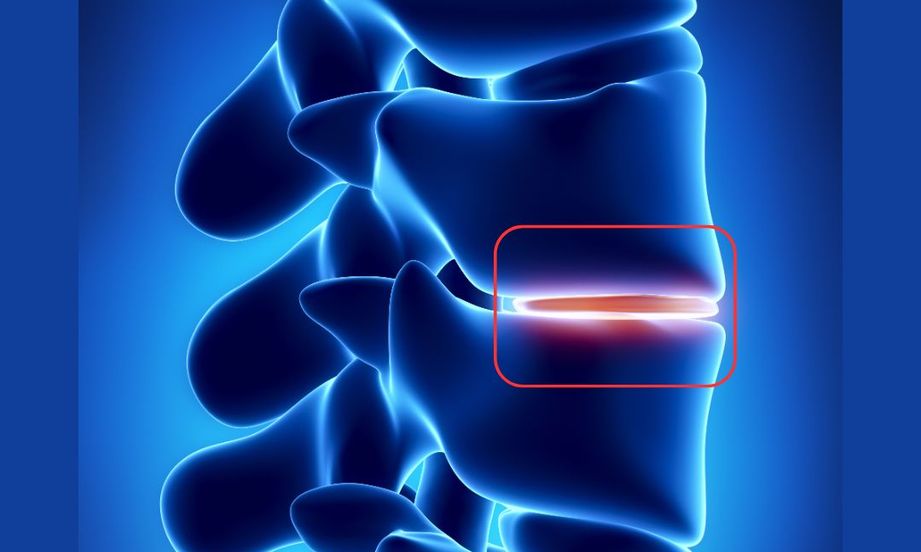 Why Lumbar Disc Degeneration Is Not the Cause of Your Back Pain