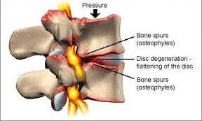 lumbar stenosis