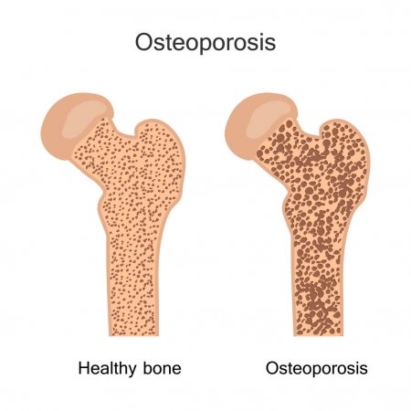 Osteoporosis Treatment and Prevention | Mesa, AZ Physical Therapy | The ...