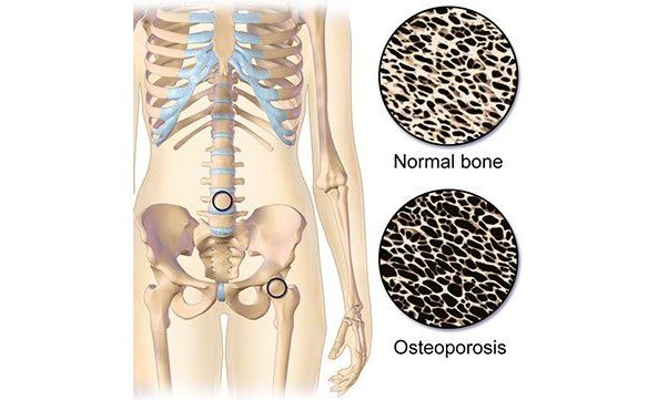 1149-osteoporosis-642×361-slide1