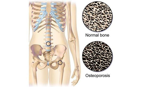 1149-osteoporosis-642&#215;361-slide1