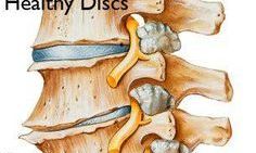 degenerative disc disease