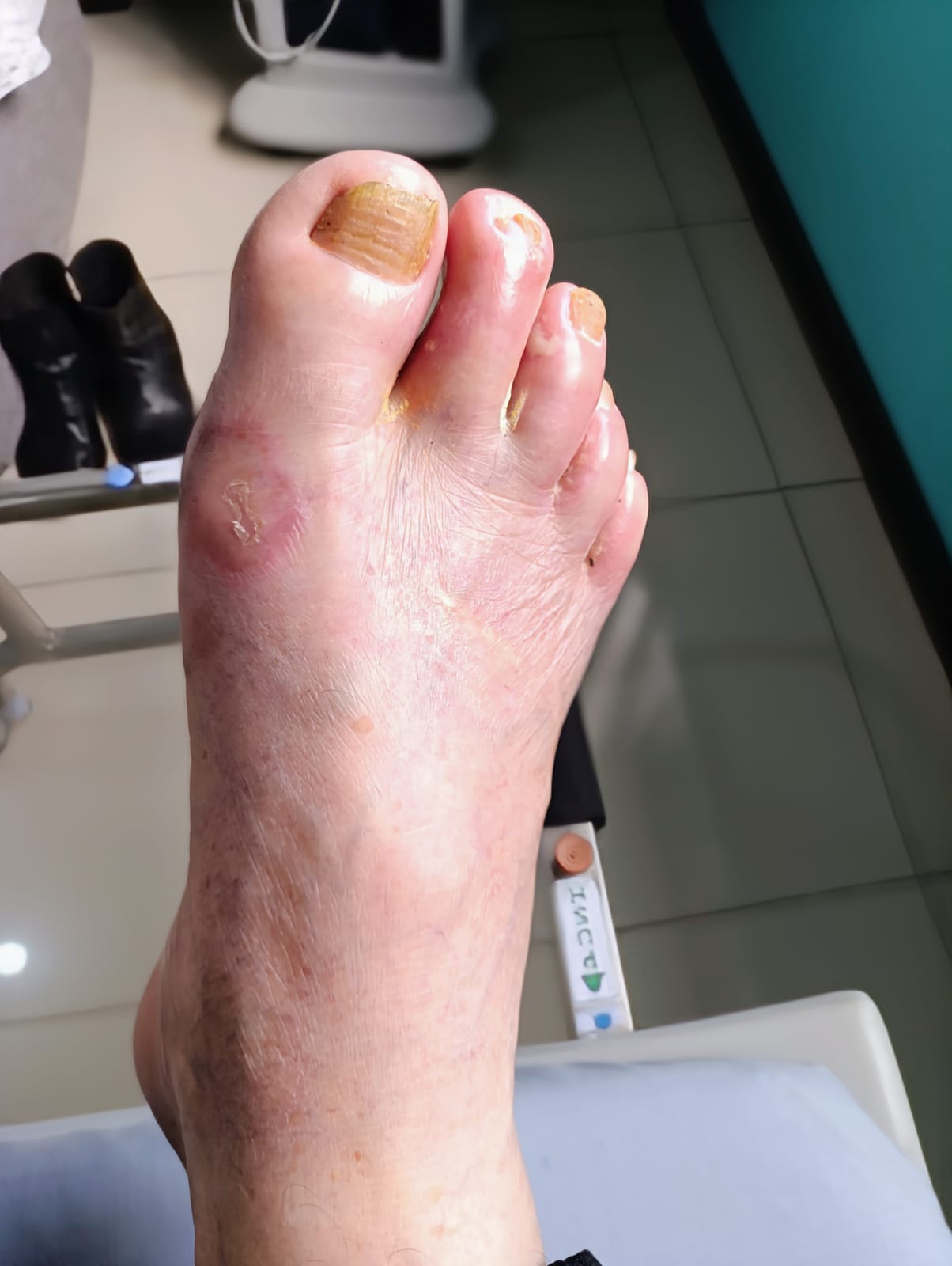 Antes: úlcera de pie diabético antes de terapia hiperbárica, San Carlos