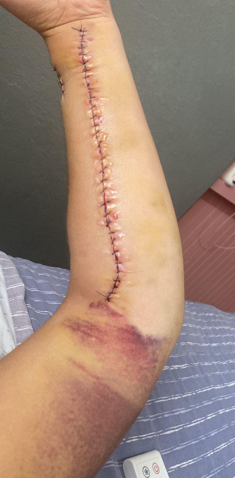 Antes: herida postoperatoria en antebrazo con osteosíntesis, San Carlos