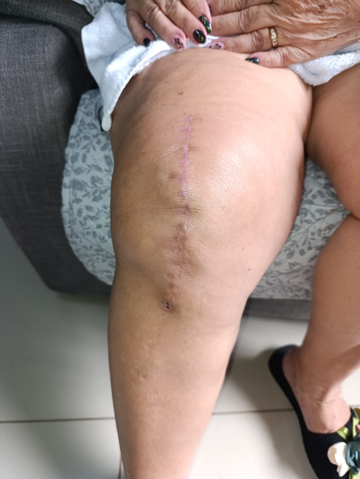 Después: recuperación funcional tras reemplazo de rodilla con cámara hiperbárica, San Carlos