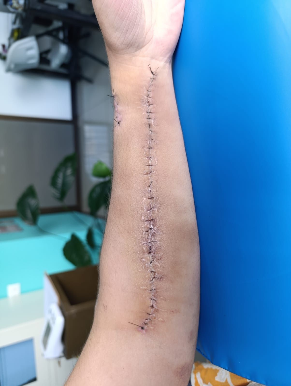 Después: cicatrización de antebrazo tras oxigenoterapia hiperbárica, San Carlos