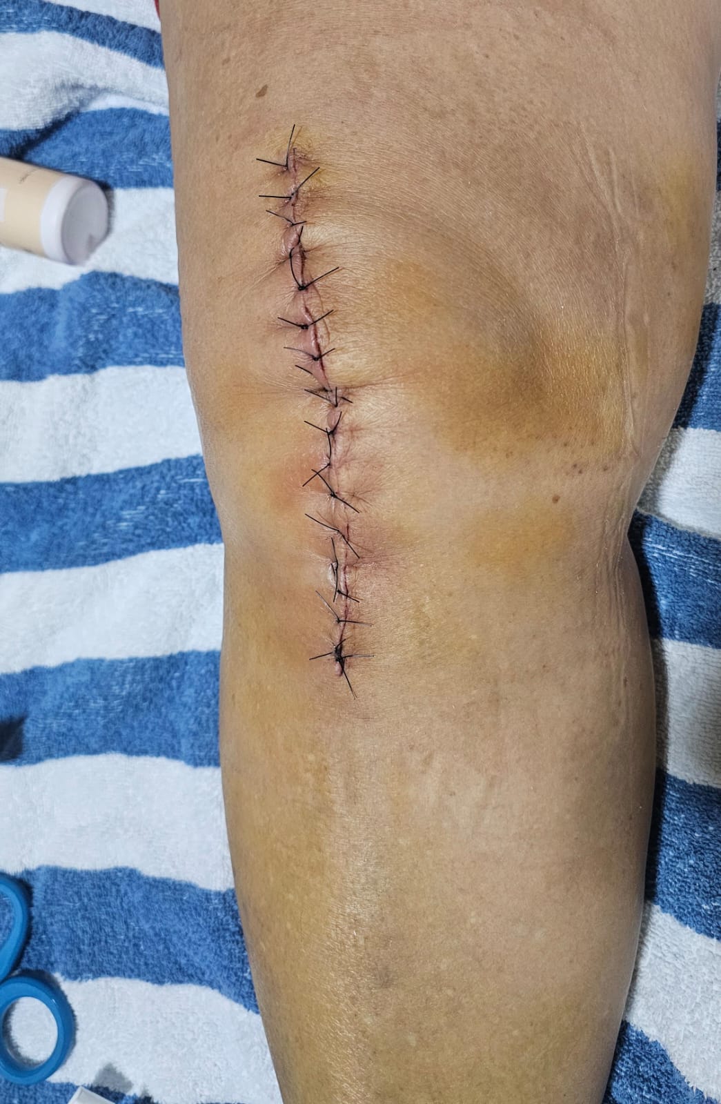 Antes: inflamación postquirúrgica tras reemplazo de rodilla, San Carlos