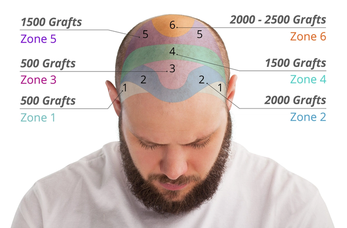 Hair Transplant Cost Guide: Global Prices & Graft Calculator Explained