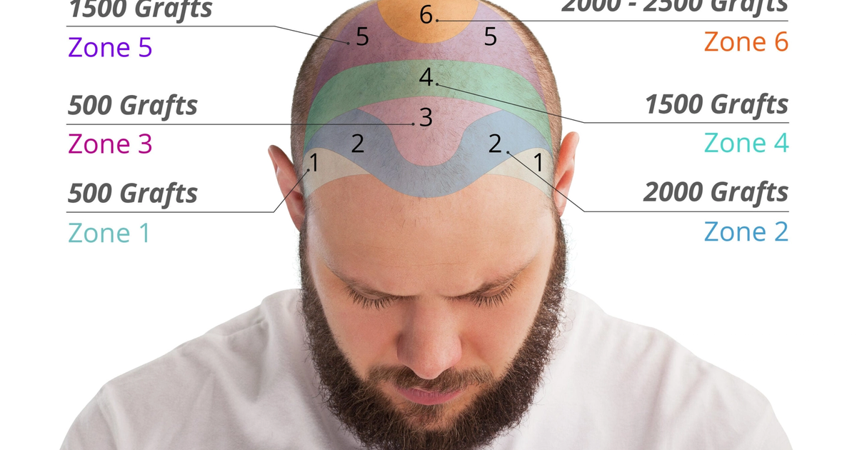 How Much Does a Hair Transplant Cost? A Global Price Guide Using a Hair Graft Calculator