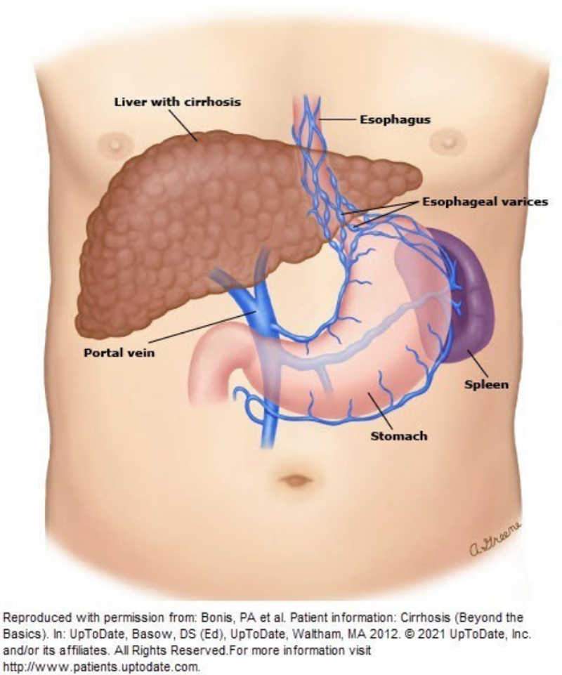 diagram showing a scarred liver and enlarged espophogeal varices