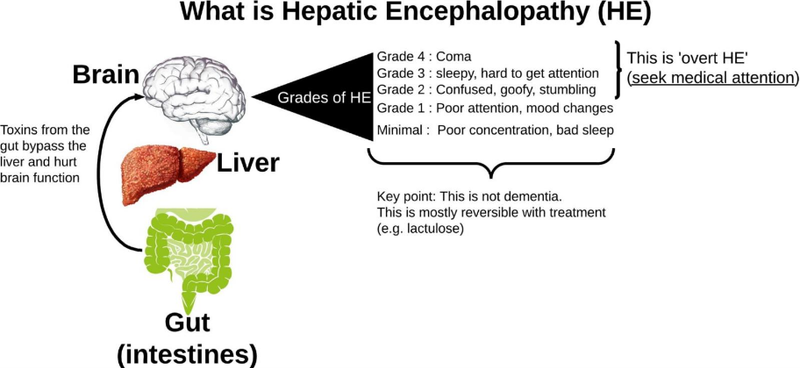 explanation of pathway between intestines and brain bypassing the liver and resulting in HE