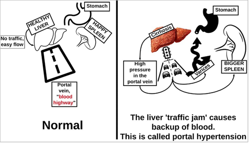 Drawing showing a normal portal vein next to a drawing of portal hypertension