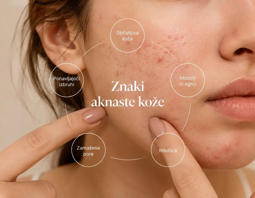 Rutina za aknasto kožo – kaj dodati, kaj odstraniti