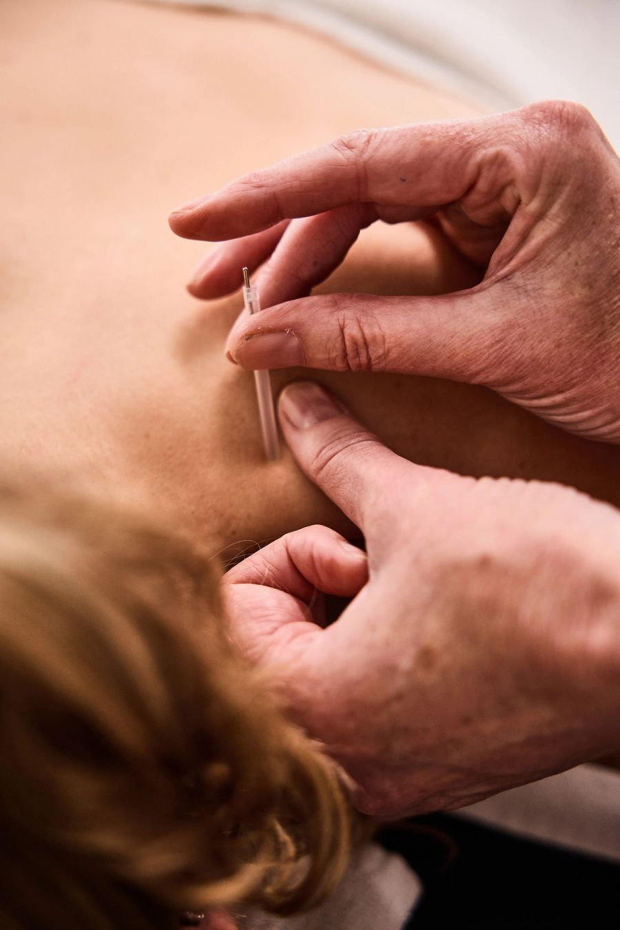 Close-up of a physiotherapist performing dry needling on a patient’s upper back