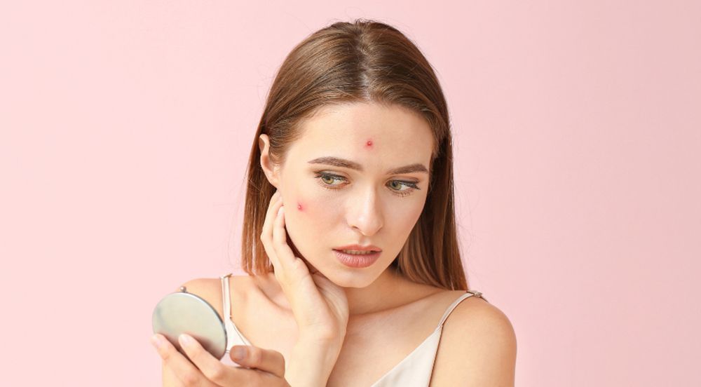 acne treatments