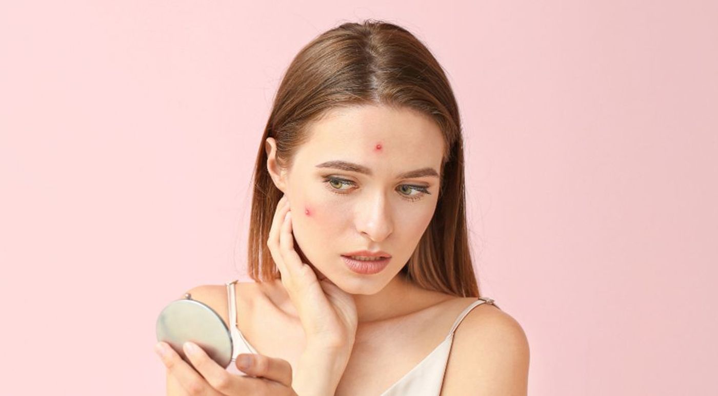 acne treatments