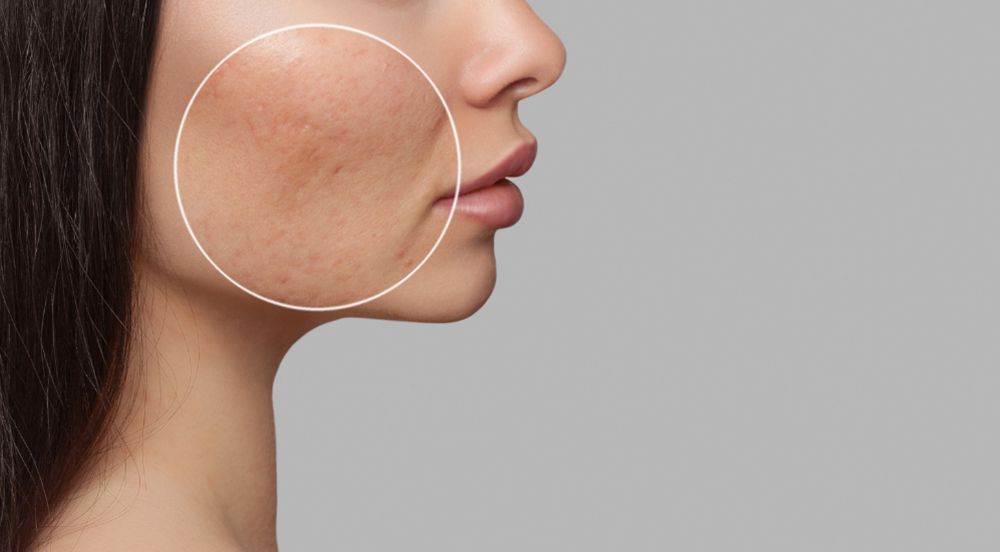 drug free acne treatment