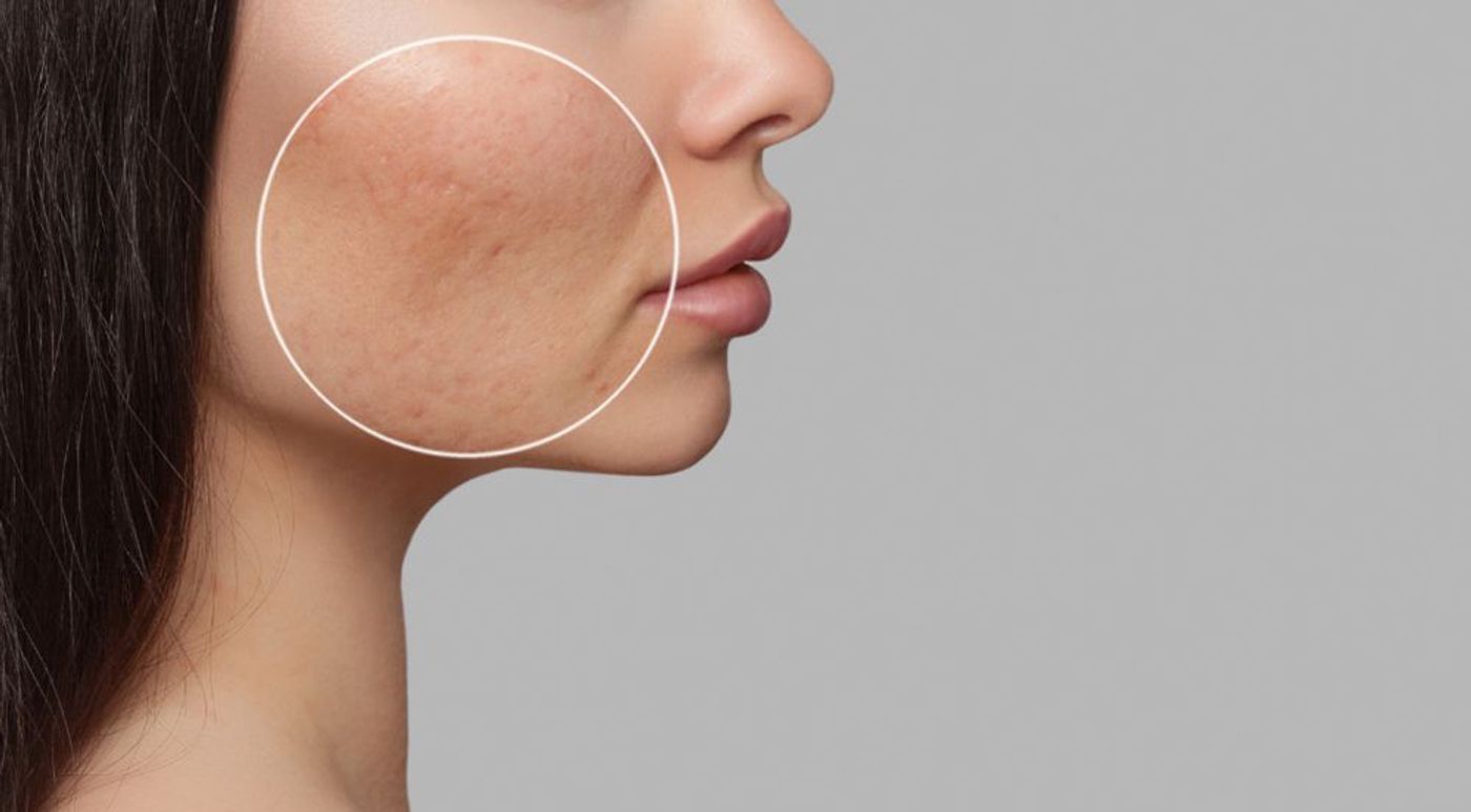 drug free acne treatment