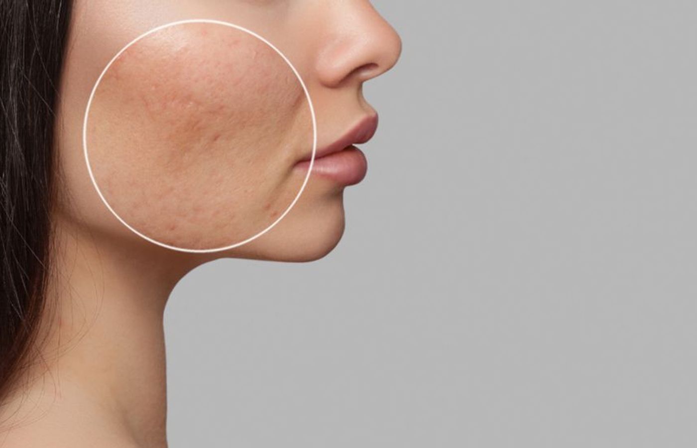 drug free acne treatment