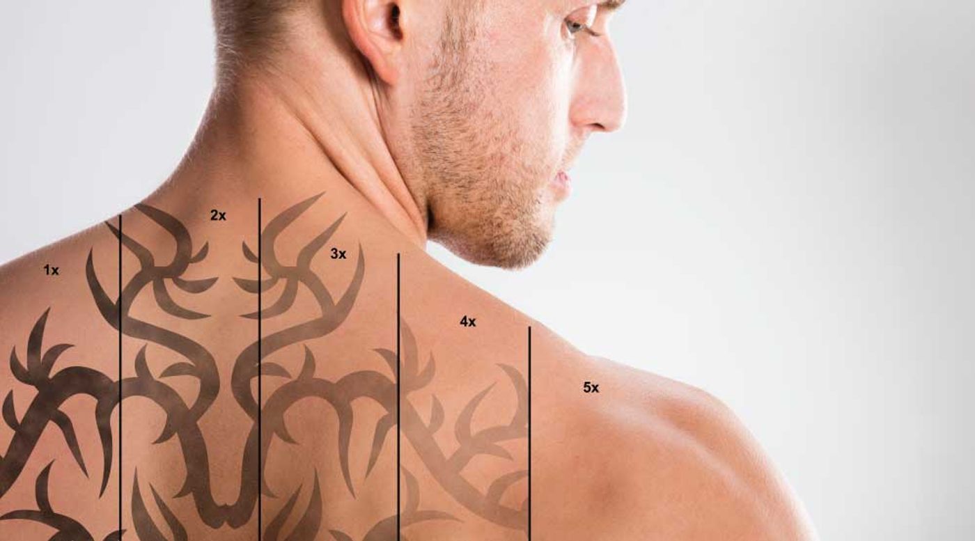 Best Ideal Methods To Remove a Tattoo