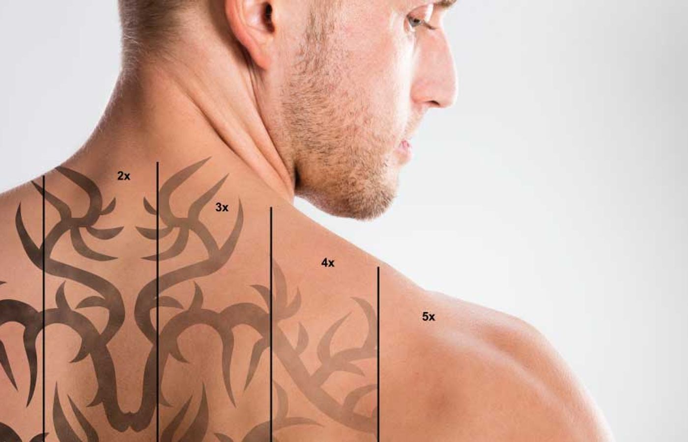 Best Ideal Methods To Remove a Tattoo