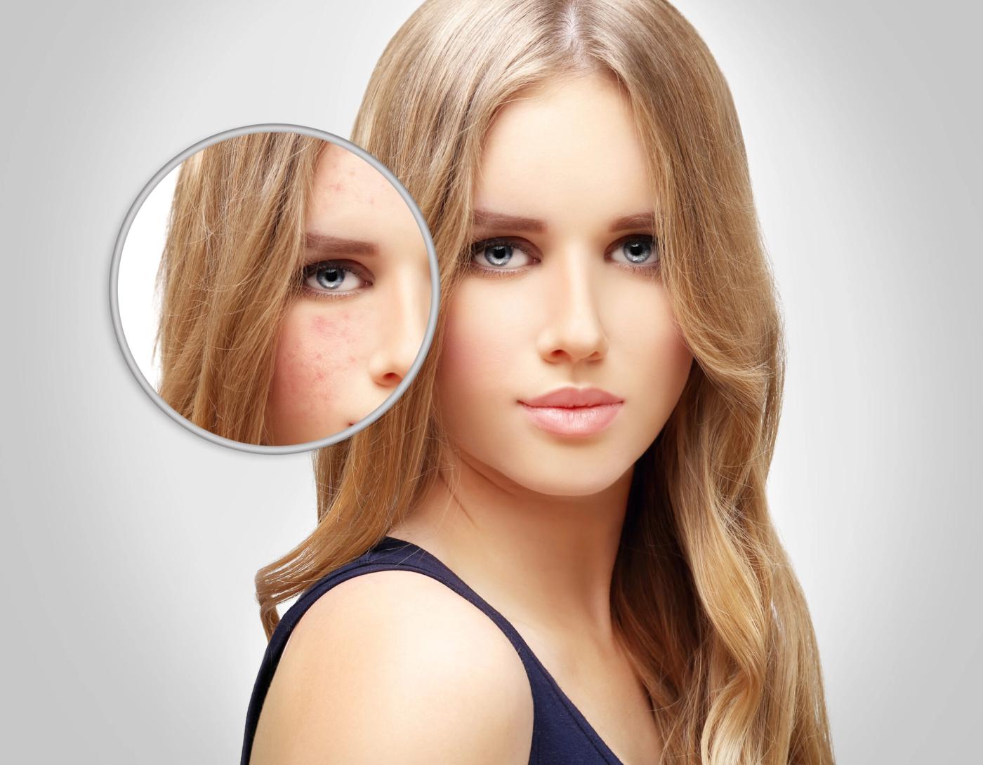When treating Acne