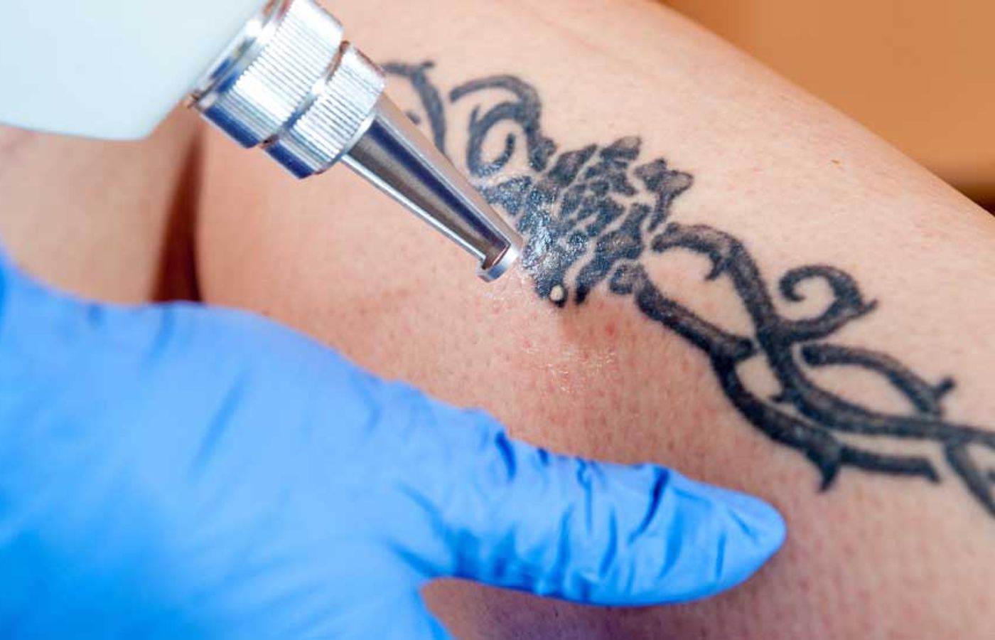 Top 5 Reasons People Get Tattoos Removed