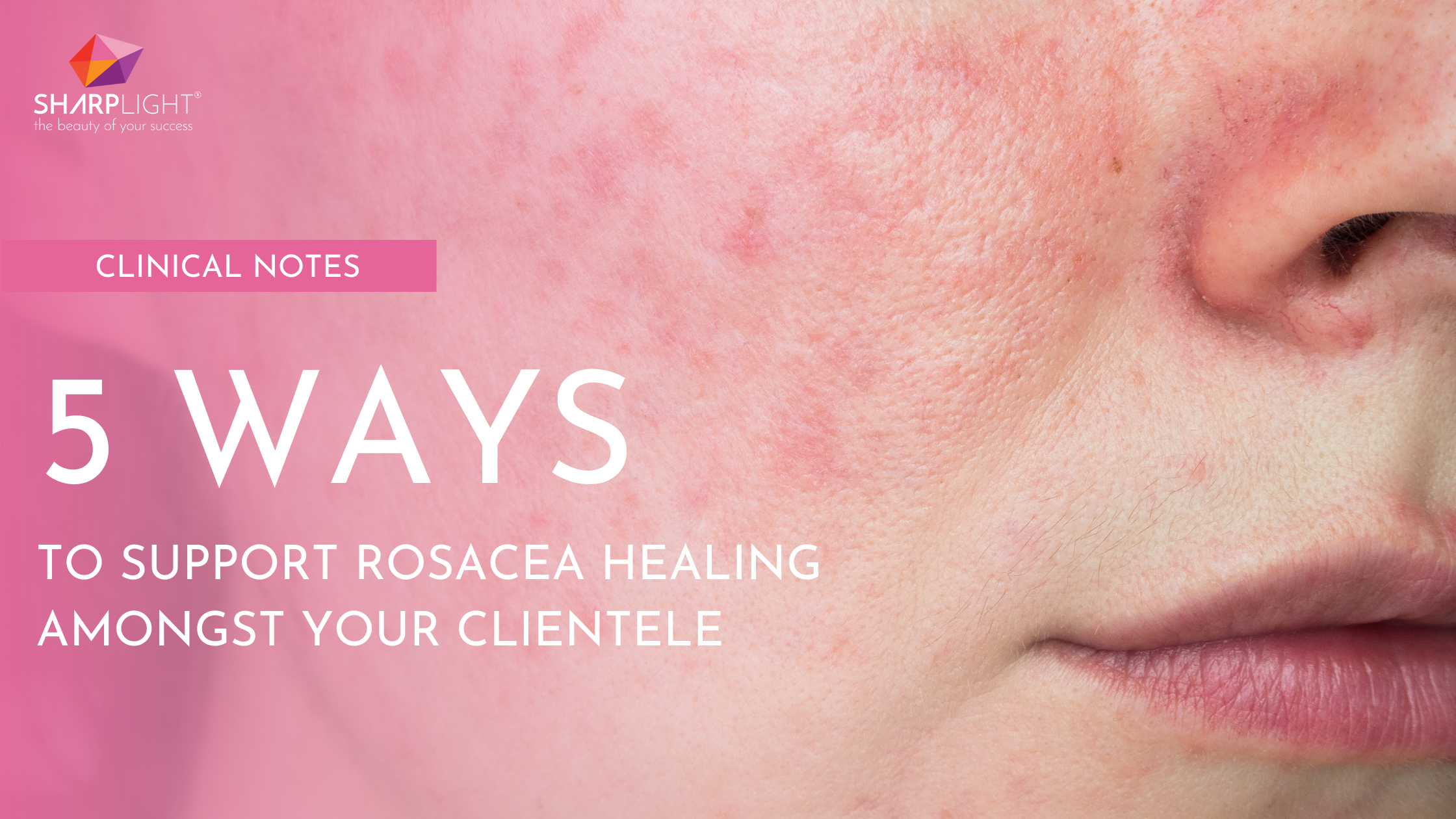 Clinical Notes: 5 Ways to Support Rosacea Healing Amongst Your Clientele 
