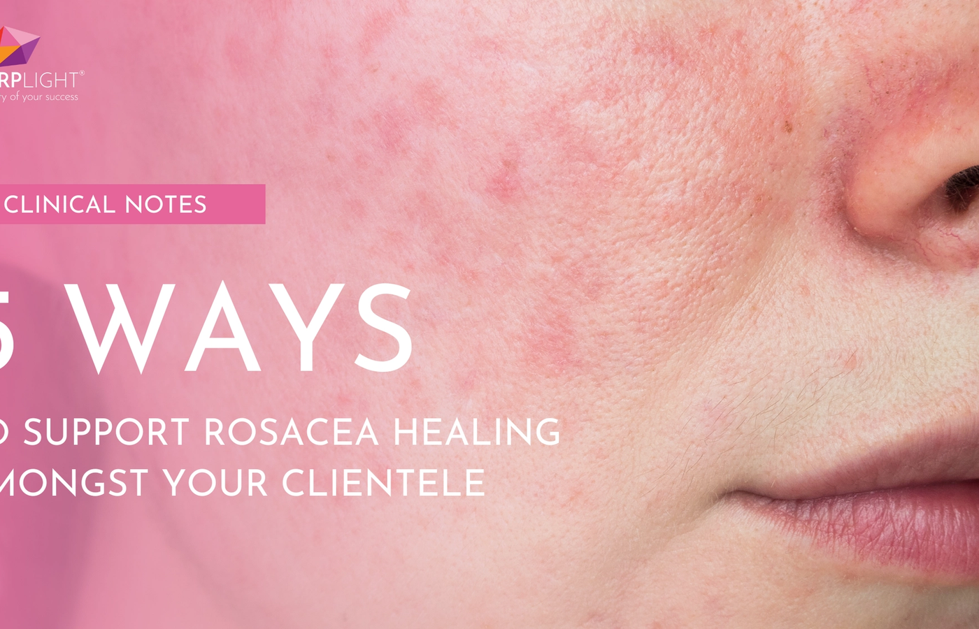 Clinical Notes: 5 Ways to Support Rosacea Healing Amongst Your Clientele