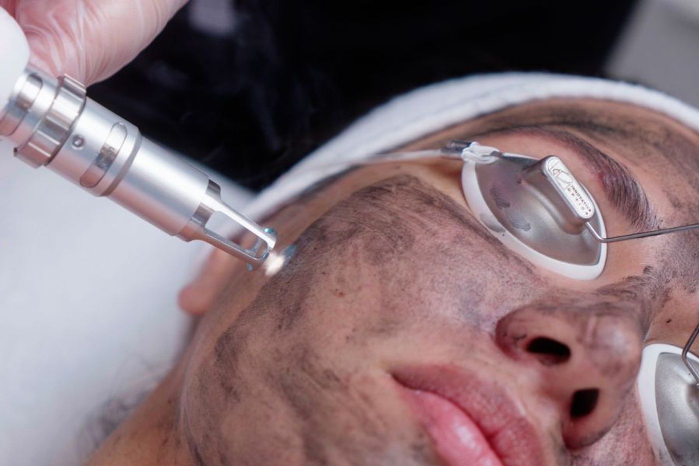 Close-up of a carbon correcting facial treatment being performed on a woman's face with laser device